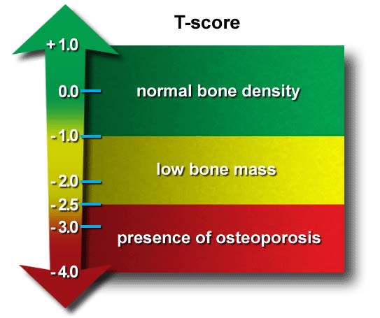 osteoporosi-2