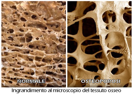 osteoporosi medea